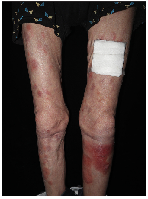 Numerous, indurated erythematous nodules and plaques on the legs.